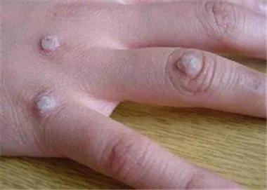 hpv高危阳补硒（hpv阳性补硒的剂量）-硒宝网