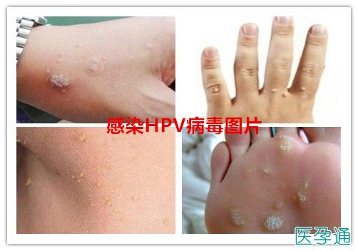 hpv高危阳补硒（hpv阳性补硒的剂量）-硒宝网