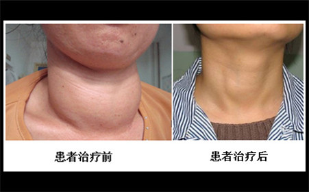 甲状腺能吃补硒吗（甲状腺患者补硒）-硒宝网