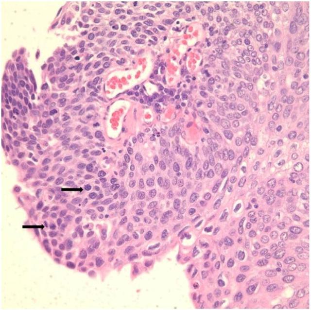 hpv高危阳补硒（hpv高危补硒有用吗）-硒宝网