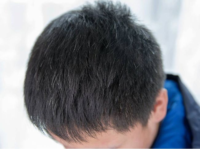 白癜风病人要补硒(硒与白斑)-硒宝网