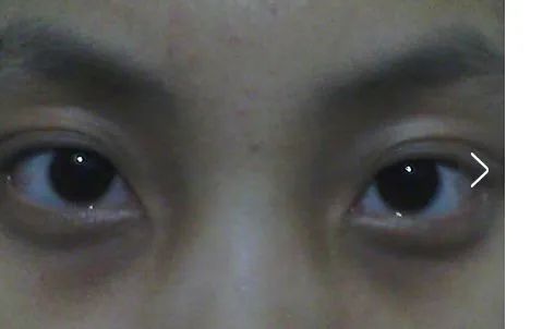 补硒降低转氨酶吗(补降低转氨酶硒的药物)-硒宝网