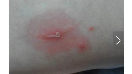 补硒降低转氨酶吗(补降低转氨酶硒的药物)-硒宝网