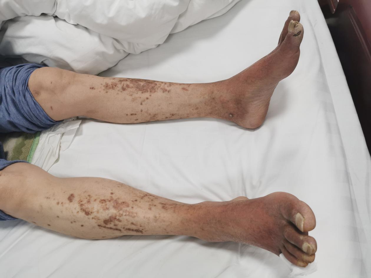 补硒治疗肌肉萎缩(肌肉萎缩补充hmb)-硒宝网