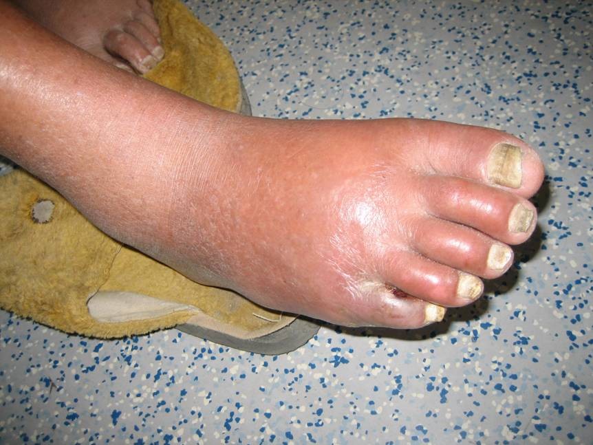 补硒治疗肌肉萎缩(肌肉萎缩补充hmb)-硒宝网