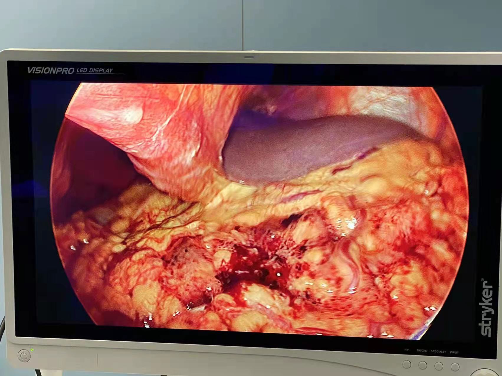 胃癌术后怎样补硒(胃癌术后可以补硒吗)-硒宝网