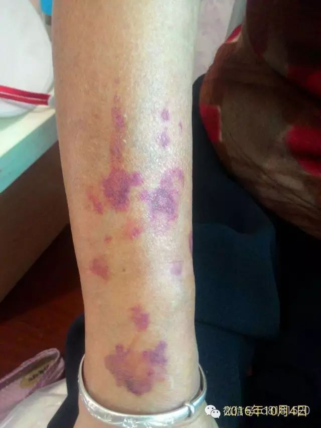 补硒脚底出现水泡(补硒脚底出现水泡)-硒宝网