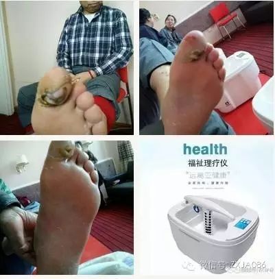 补硒脚底出现水泡(补硒脚底出现水泡)-硒宝网