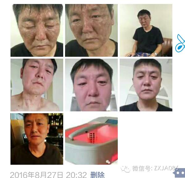 补硒脚底出现水泡(补硒脚底出现水泡)-硒宝网