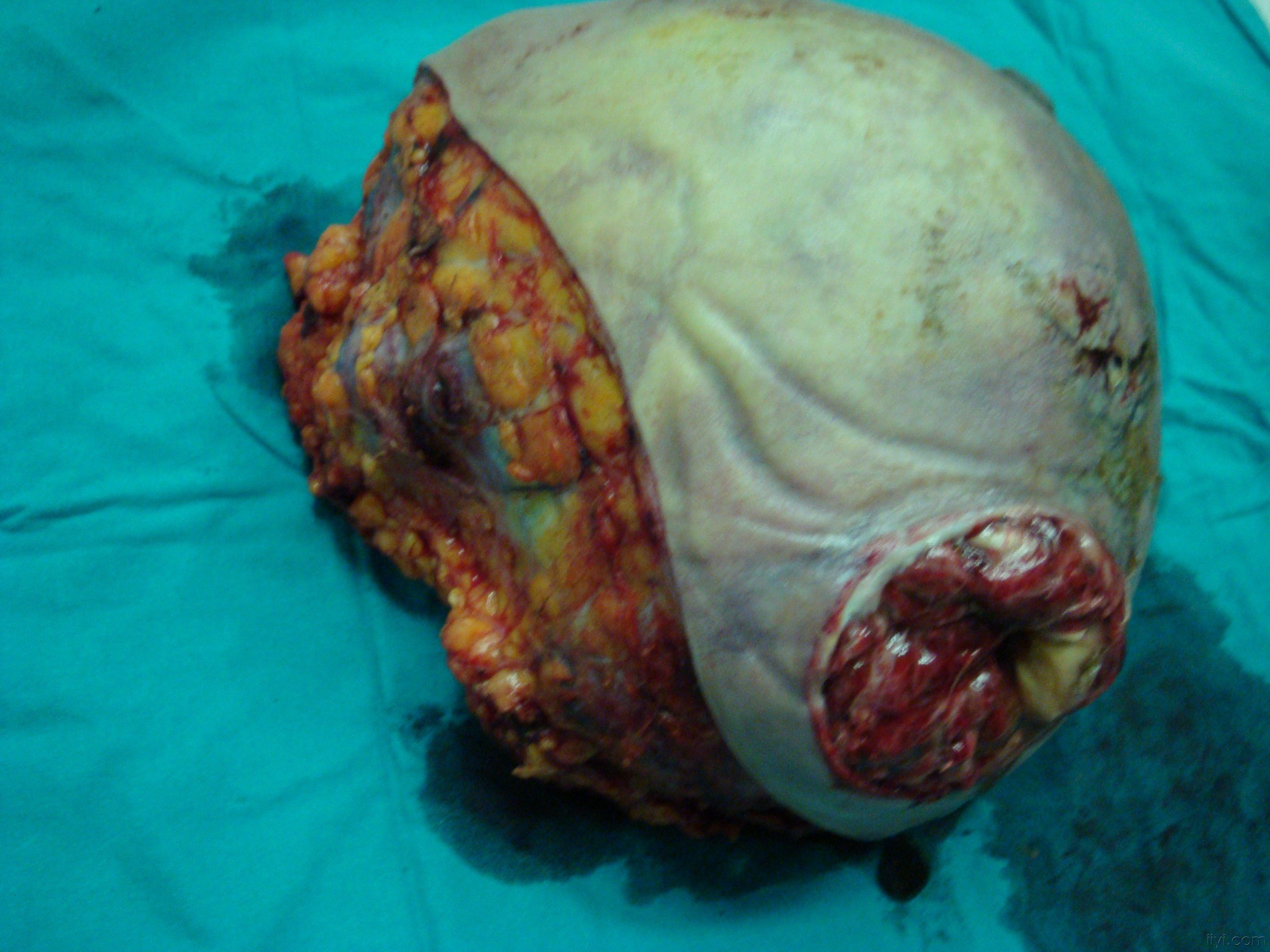 补硒预防肺部疾?。ㄔし婪尾考膊〔刮杏寐穑?硒宝网