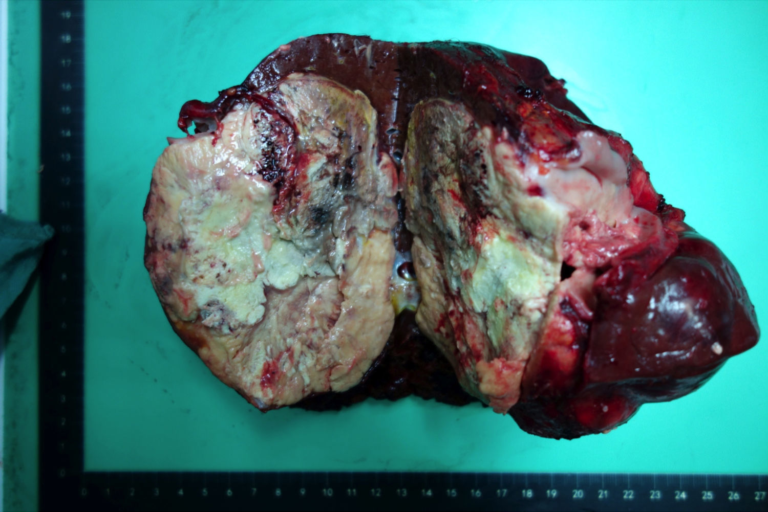 预防大于治疗补硒(如何预防硒缺乏)-硒宝网