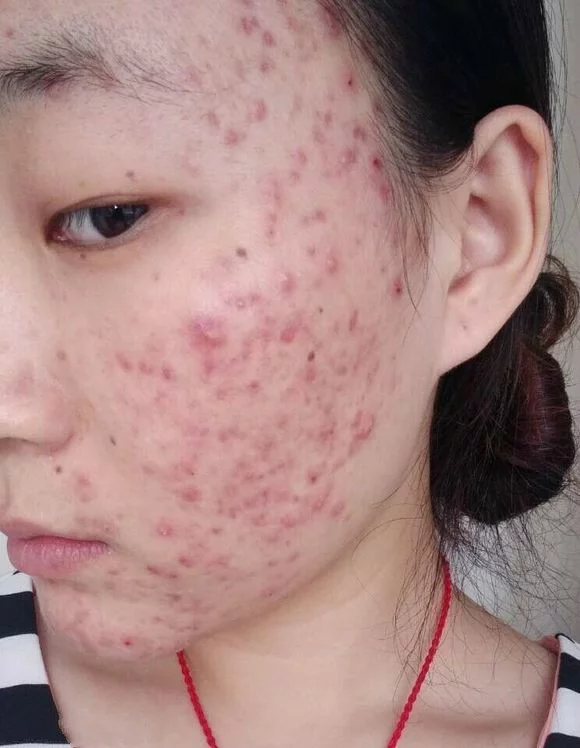 补硒后脸上起痘痘（吃硒片长痘痘）-硒宝网