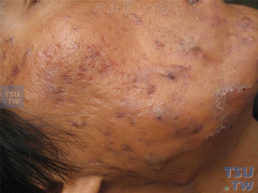 补硒后脸上起痘痘（吃硒片长痘痘）-硒宝网