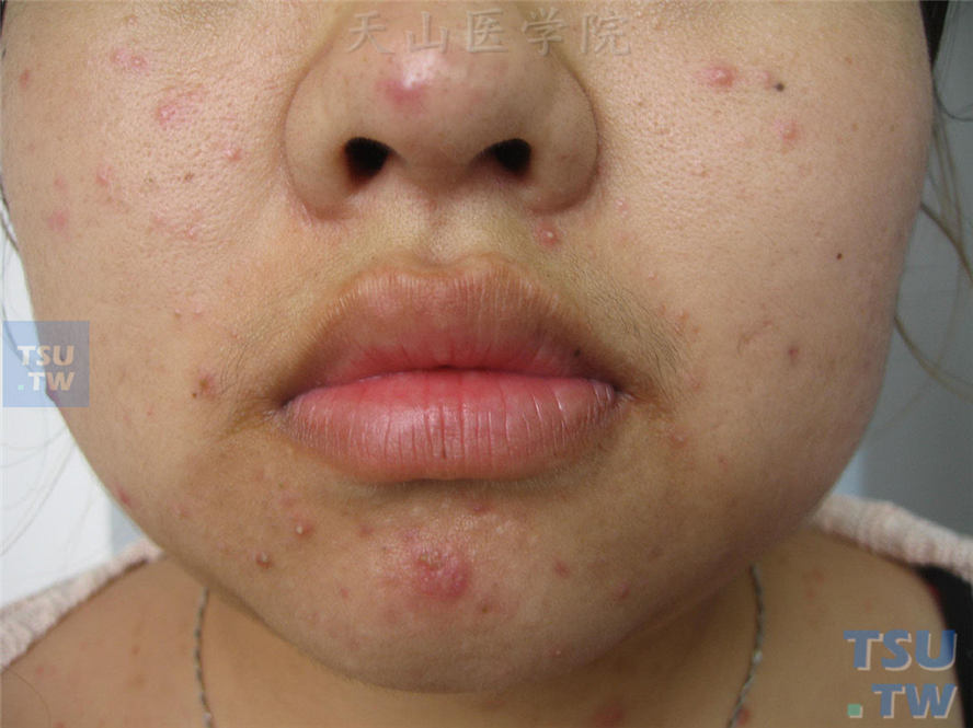 补硒后脸上起痘痘（吃硒片长痘痘）-硒宝网