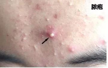 补硒后脸上起痘痘（补硒会长痘吗）-硒宝网