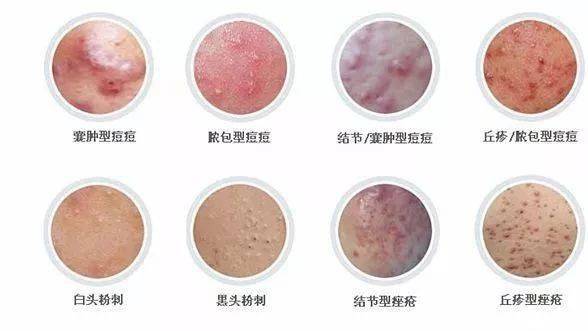 补硒后脸上起痘痘（补硒会长痘吗）-硒宝网