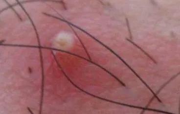 补硒后脸上起痘痘（补硒会长痘吗）-硒宝网