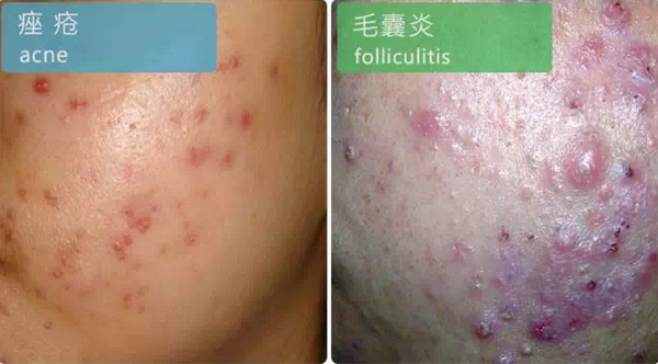 补硒后脸上起痘痘（补硒会长痘吗）-硒宝网