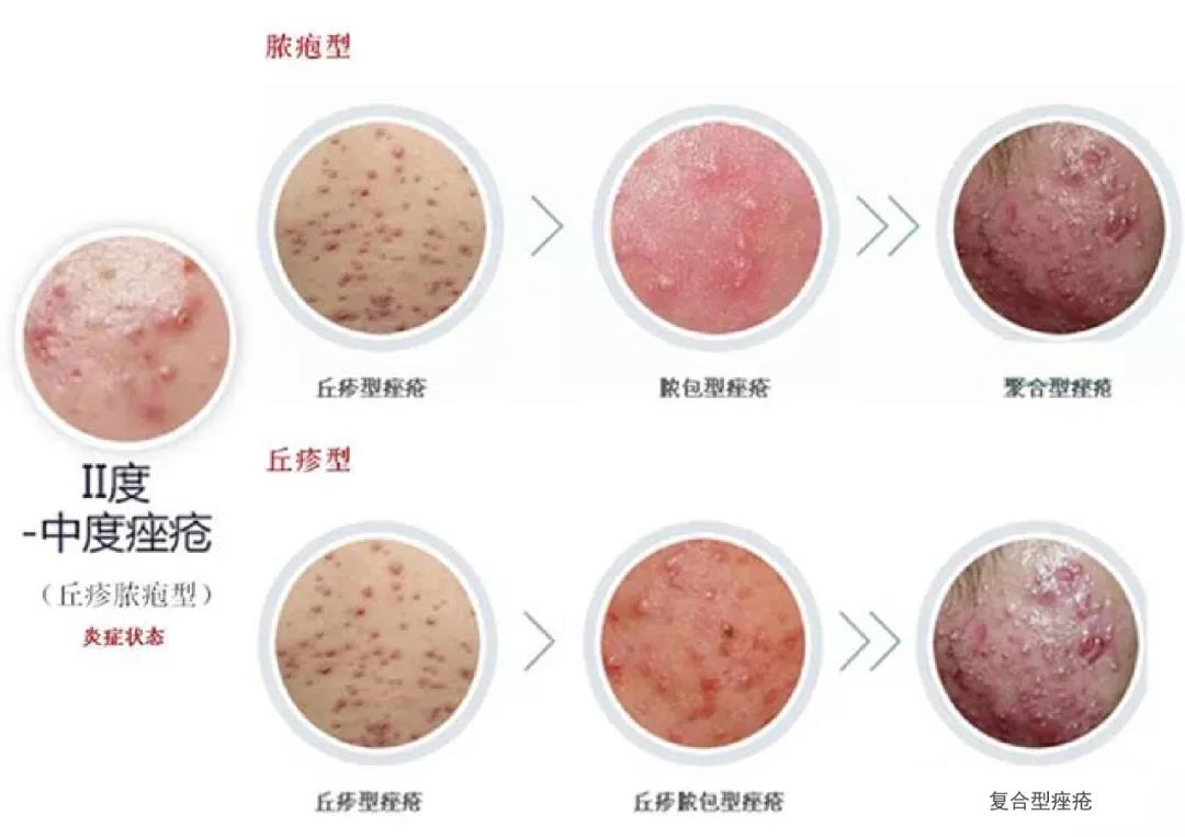 补硒后脸上起痘痘（吃硒片会长痘吗）-硒宝网