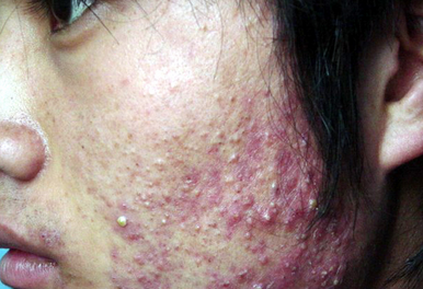 补硒后脸上起痘痘（吃硒片会长痘吗）-硒宝网