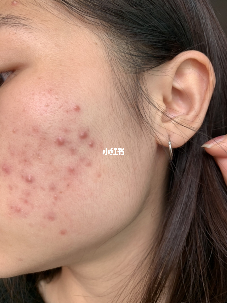 补硒后脸上起痘痘（吃硒片会长痘吗）-硒宝网