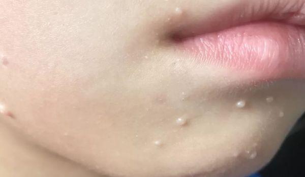 有hpv能补硒吗(吃硒对hpv有效果吗)-硒宝网