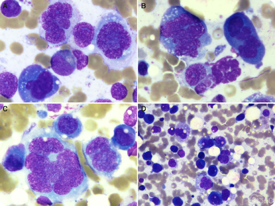 肺癌补硒研究成果(肺癌补硒)-硒宝网