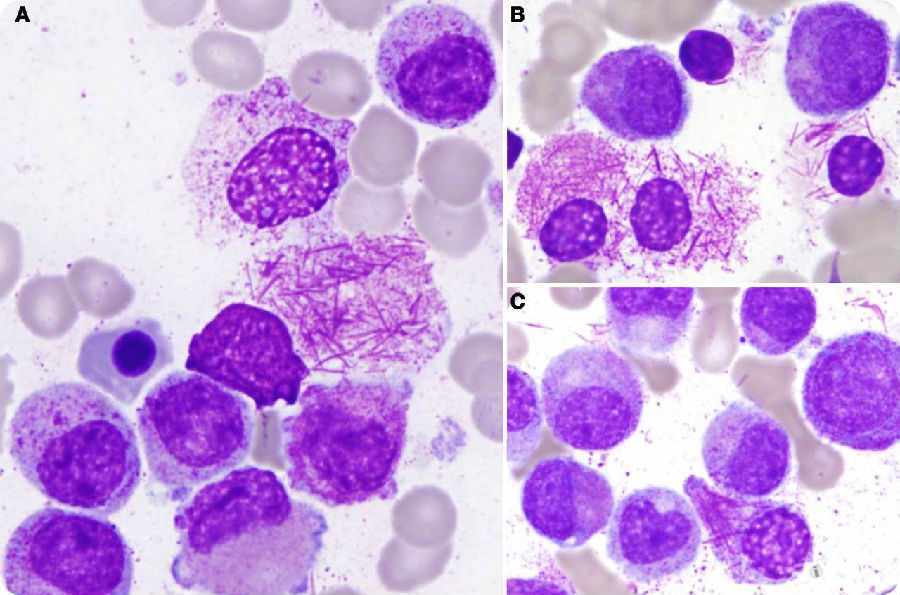 肺癌补硒研究成果(肺癌补硒)-硒宝网