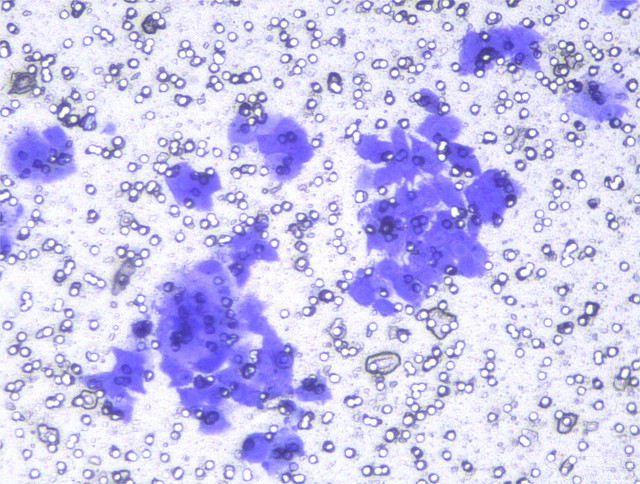 肺癌补硒研究成果(肺癌补硒)-硒宝网