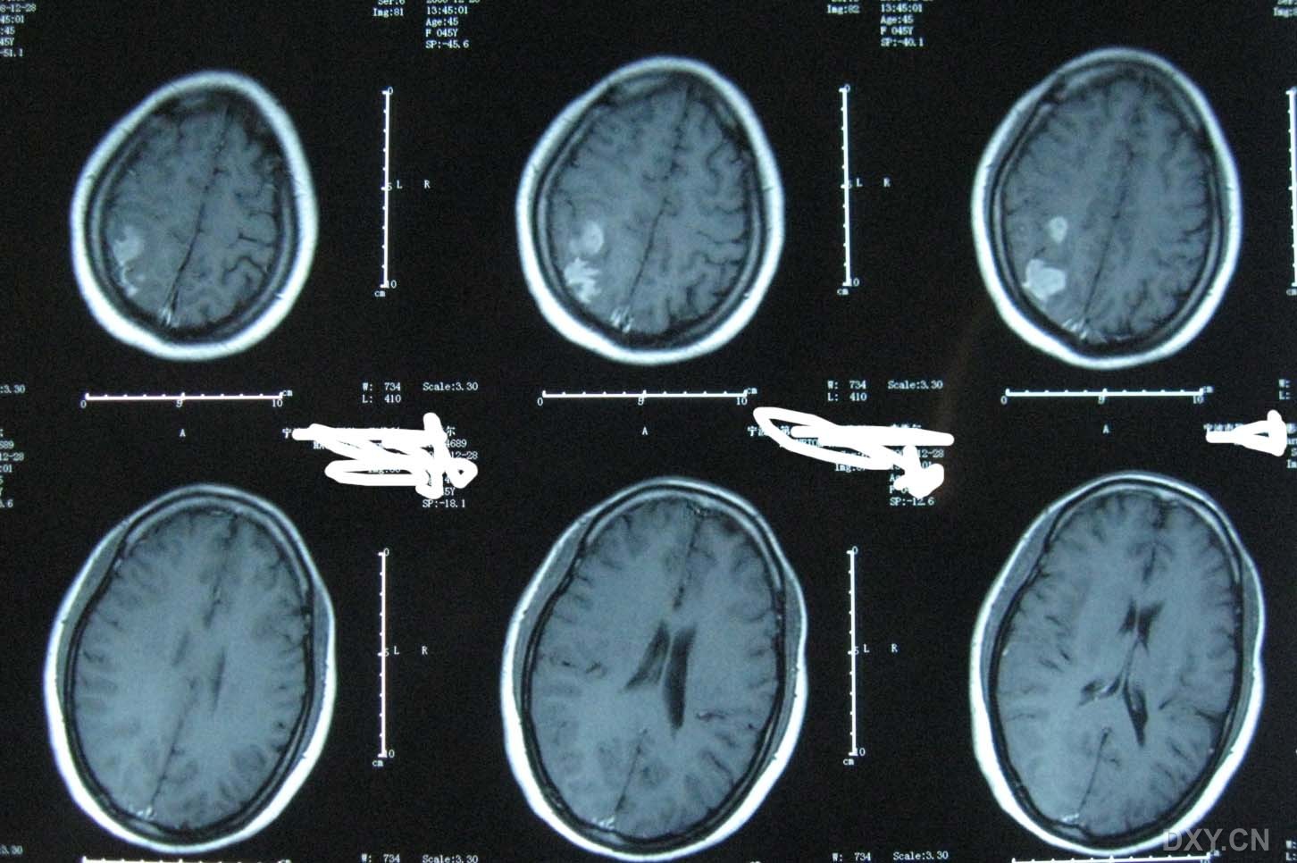 肺癌补硒研究成果(肺癌补硒)-硒宝网