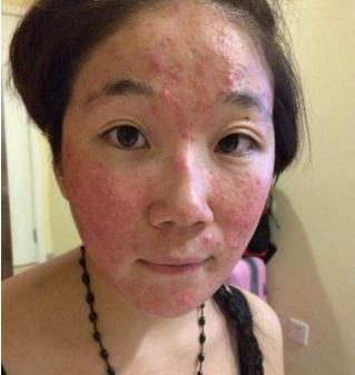 乳癌有必要补硒吗（乳腺癌补硒）-硒宝网