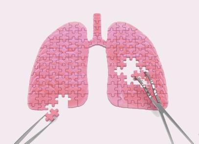 肺腺癌需要补硒吗(肺癌补硒吃什么药)-硒宝网