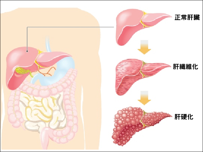 补硒对肝病的疗效（肝病补硒）-硒宝网