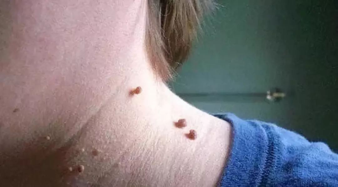 hpv扁平疣补硒（硒片对扁平疣有用处吗）-硒宝网