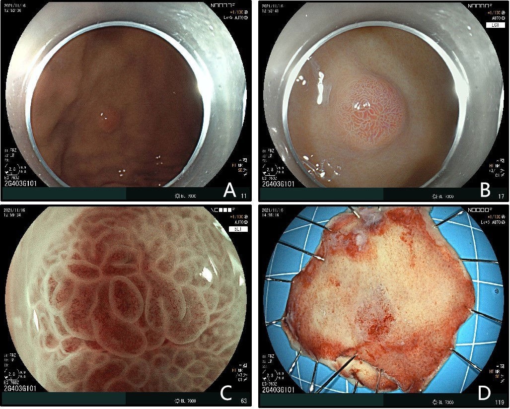 喉癌患者可补硒吗(有吃硒治好癌症的么)-硒宝网