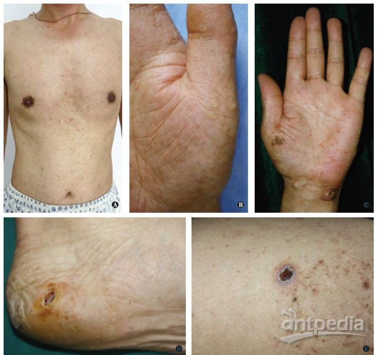 喉癌患者可补硒吗(硒对癌症)-硒宝网