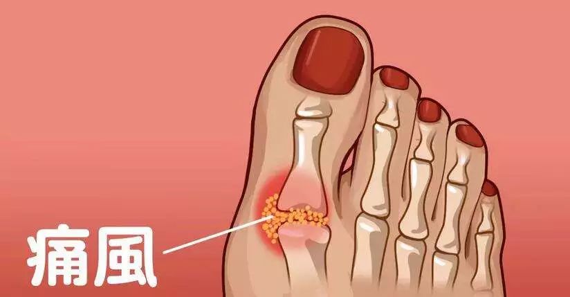 痛风补硒有好处吗(硒对疼风有什么好处)-硒宝网