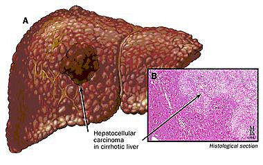 乙型肝炎补硒行吗(乙肝补硒)-硒宝网