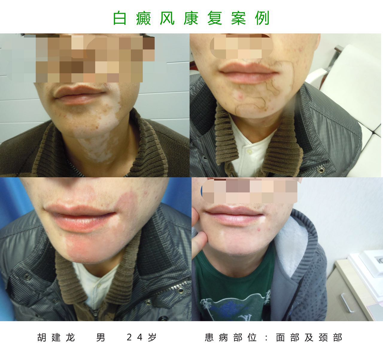 锌硒补多了会咋样（补锌硒有副作用吗）-硒宝网