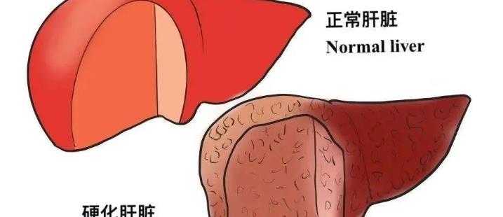 肝病为什么要补硒（补硒治愈了我的肝病）-硒宝网