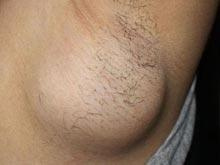 甲状腺癌过量补硒(甲癌补硒好吗)-硒宝网