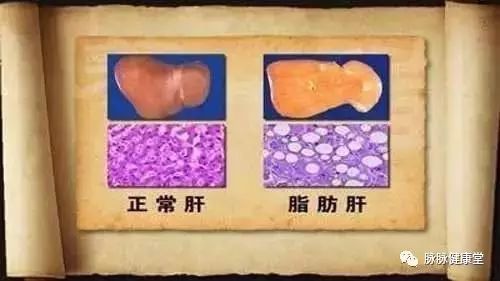 胆结石可以补硒吗(硒对胆结石有什么好处)-硒宝网