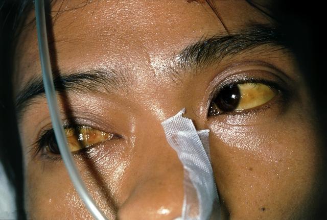 肝肿瘤可以补硒吗（肿瘤肝补硒可以长期吃吗）-硒宝网