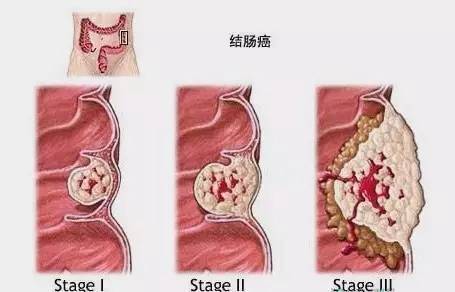脑肿瘤需要补硒吗(在肿瘤治疗中补充硒元素)-硒宝网