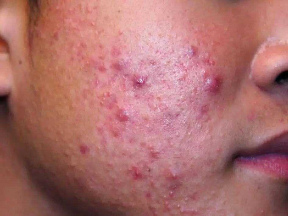 补硒以后爆痘厉害（爱美得痘胶膏用一次爆痘还痒）-硒宝网