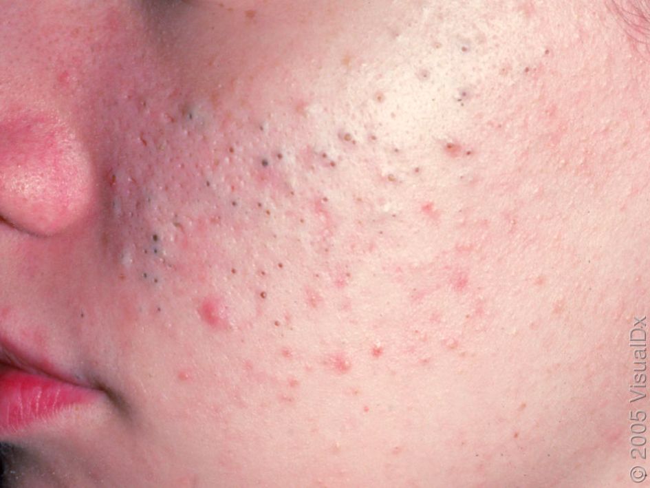 补硒以后爆痘厉害（爱美得痘胶膏用一次爆痘还痒）-硒宝网