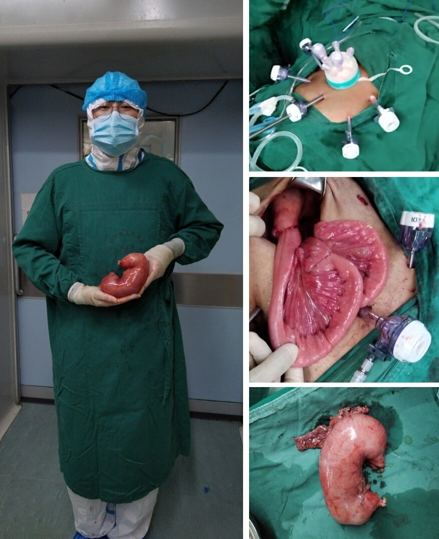 肠梗阻需要补硒吗(肠梗阻需要补液吗)-硒宝网