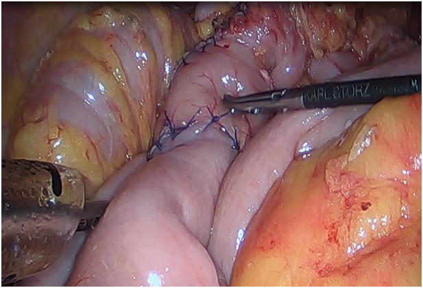 肠梗阻需要补硒吗(肠梗阻需要补液吗)-硒宝网