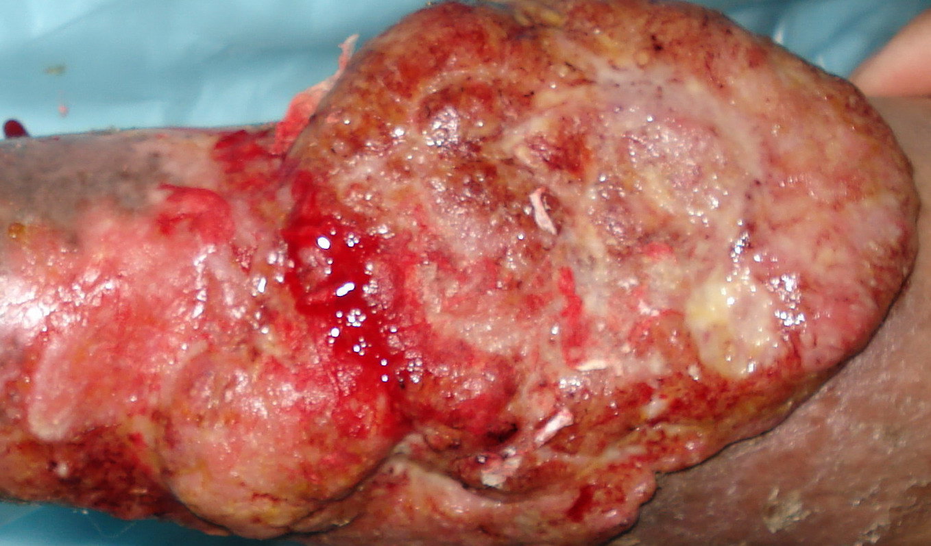 化疗必须要补硒吗(化疗补硒吃什么药)-硒宝网