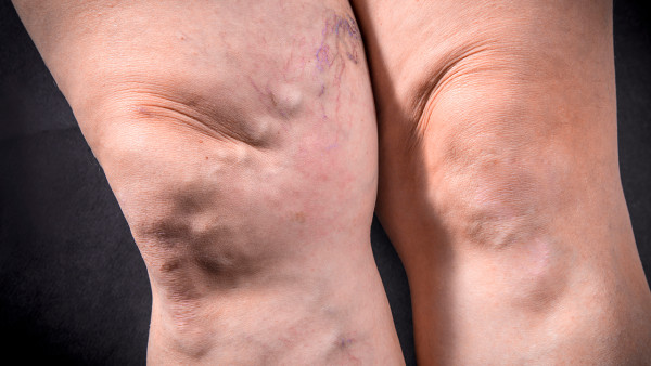 补硒可以治痛风么(治补痛风硒可以长期吃吗)-硒宝网